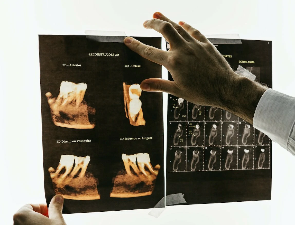 Micro-Endodontic Surgery